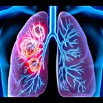 What is mesothelioma? This form of cancer affects lung tissue and can cause significant symptoms, including chest pain and difficulty breathing.