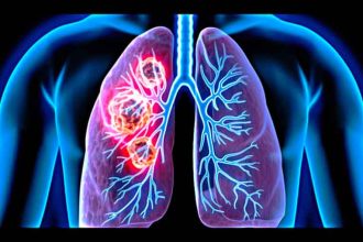 What is mesothelioma? This form of cancer affects lung tissue and can cause significant symptoms, including chest pain and difficulty breathing.