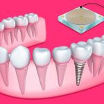 3 Things You Should Know Before You Get Your Dental Implants