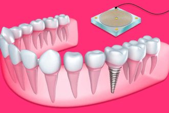 3 Things You Should Know Before You Get Your Dental Implants