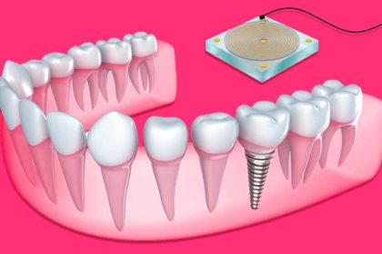 3 Things You Should Know Before You Get Your Dental Implants