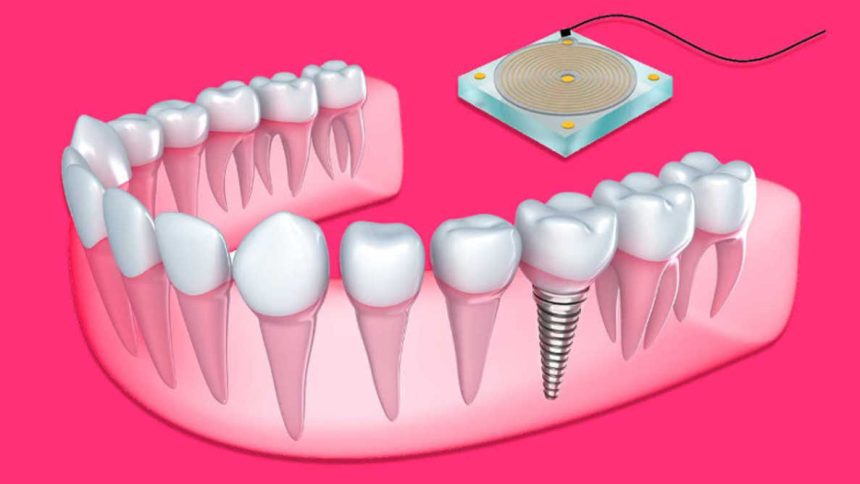 3 Things You Should Know Before You Get Your Dental Implants