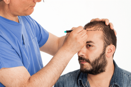 All you need to know about Hair Transplant and it Cost?