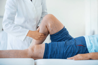 How long does it take for varicose veins to disappear after laser treatment? Varicose veins are knotted, unsightly veins caused by blood assembling in the legs. They are frequently inflated, bulging, and winding veins that might be blue or dark purple. Varicose veins rarely require medical treatment, but if you experience swelling, hurting, aching legs, and significant discomfort, you should seek professional help. Laser treatment for varicose veins is a common and effective way to manage them. There is always a danger of problems when adequate blood flow is compromised. Bleeding, thrombophlebitis (blood clots in the leg veins), chronic venous insufficiency, and unattractive veins observable just beneath the skin are some of the risks. Endovenous laser treatment is used to treat more prominent varicose veins in the legs. A laser fiber is inserted into the vein through a catheter, and the technician monitors the vein on an ultrasound screen. You will need to wear compression stockings for a week or two following endovenous laser therapy. Patients are urged to begin walking immediately following the surgery. Still, they should avoid any rigorous leg exercises (such as weight training) for two to three weeks to allow for proper healing and closure of the treated veins. For two to four weeks, there is bruising and minor soreness in the treated limb. Patients may notice a reduction in the noticeability of their varicose veins within a week, but full results may take weeks to months. Depending on the degree of their varicose veins, some individuals may require further treatment. Some ways to care for yourself pre and post laser treatment are: Talk about medications and drug use: Ask your doctor if there are any modifications you should make before the operation when you visit with him or her. For example, if you smoke, you should stop because tobacco can cause healing to be delayed. Examine all of your drugs, herbs, and supplements. Some may have an impact on how you react to anesthesia. Others may increase the risk of bleeding. You might have to stop taking some the day before your surgery or even the day before. Work out and do stretches: As you heal, it's critical to keep blood circulating through your legs. Three to four times, pump your ankles. This should be done every 10 minutes. Walk around for 10 to 15 minutes at a time once an hour. You can begin right away after you return home from the hospital. This lowers your chances of getting a blood clot. As you gain strength, increase your daily activity by a small amount. Keep an eye out for possible issues: Ensure you are aware of the warning signs and symptoms of significant surgical complications. Keep an eye out for increased discomfort, redness, or swelling in your leg. These symptoms could indicate an infection or a blood clot. If your leg bleeds, you have a fever, or clot symptoms, call your doctor immediately. The procedure may also impact the nerve near the varicose vein; however, this is uncommon. After getting laser treatment for varicose veins, don't get behind the wheel for at least three days. Do not drive if your doctor has recommended narcotic pain medication. Healing time following varicose vein surgery is usually one to four weeks. During that period, you should avoid or reduce many of your normal activities. For at least two weeks, avoid hard lifting and strenuous exercise. However, everyone recovers in their own unique way.