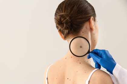 Skin Cancer