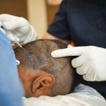 Why Pune is the Best Destination for Hair Transplant