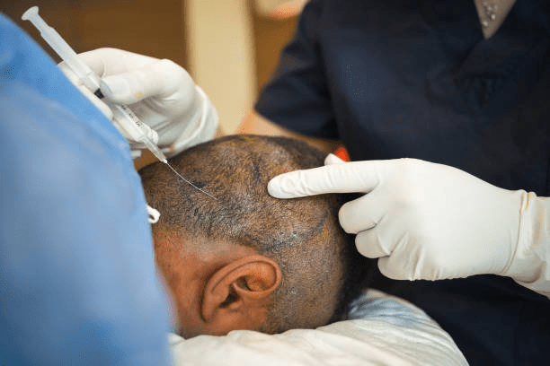 Why Pune is the Best Destination for Hair Transplant