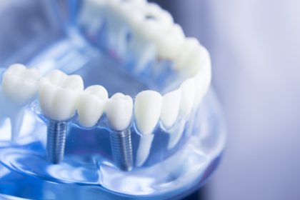 The Complete Guide to Selecting Dentists for Implants: What to Know