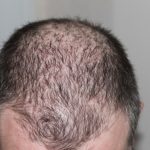 The Big 3 Of Hair Loss Treatments