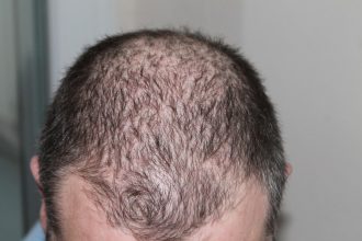 The Big 3 Of Hair Loss Treatments