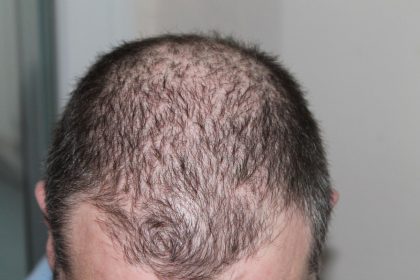 The Big 3 Of Hair Loss Treatments