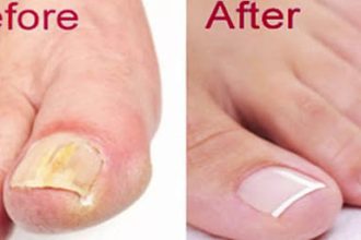One cup of this will destroy your fingernail fungus