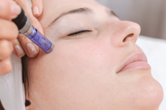 Microneedling Versus Laser Treatments, Which One Is Better For Your Skin?