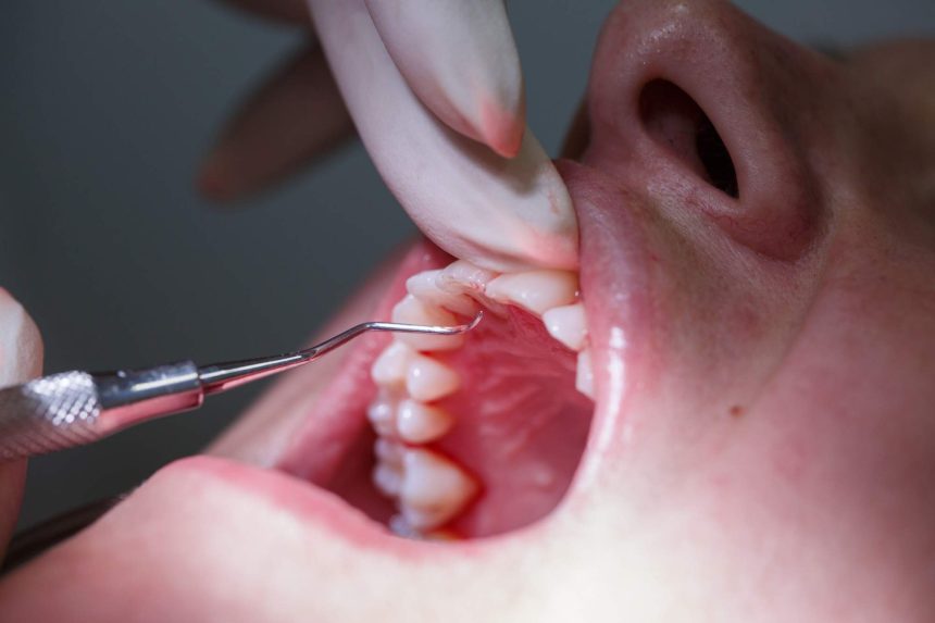 Is Composite Resin Right for Your Fillings? A Closer Look