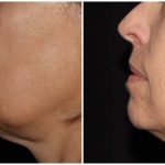 Bellafill: The Amazing Benefits