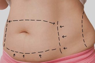 All Things You Need to Know About Mommy Makeover Procedure 