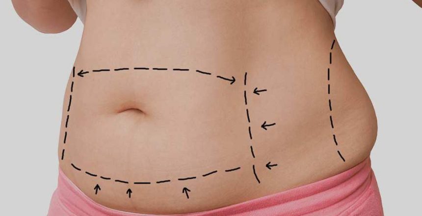 All Things You Need to Know About Mommy Makeover Procedure 
