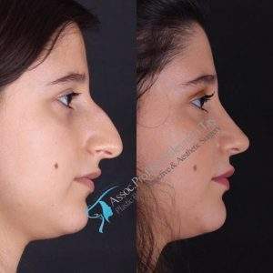 Open vs Closed Rhinoplasty