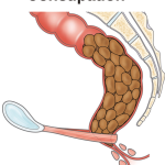 A Guide to Constipation Relief