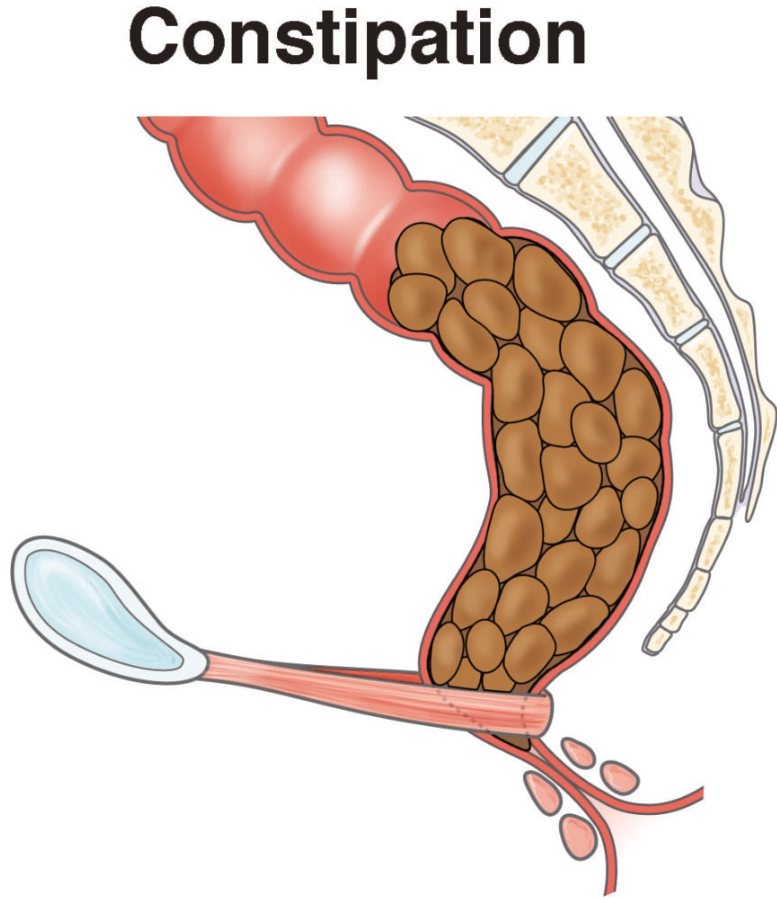 A Guide to Constipation Relief