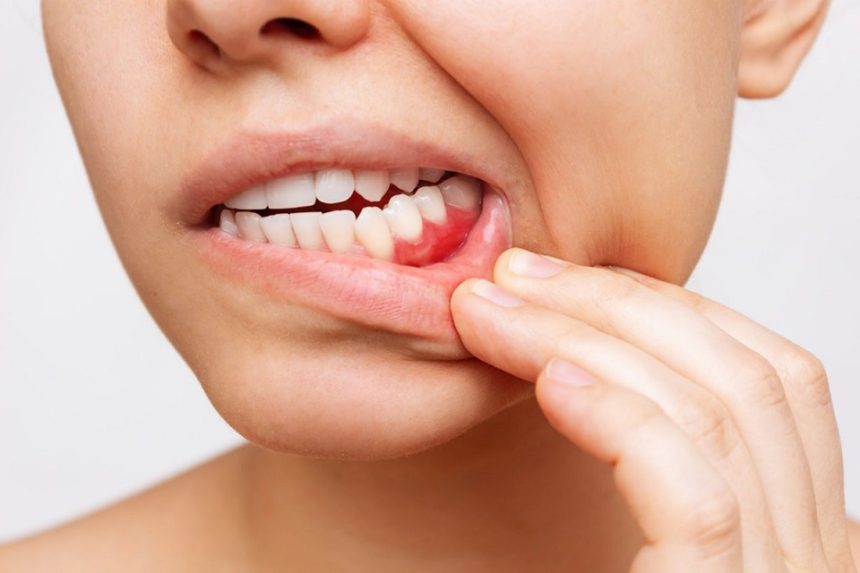 Preventing Gum Disease Is Easier than You Think