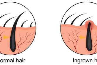 Ingrown Hair