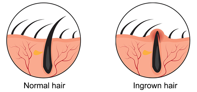 Ingrown Hair