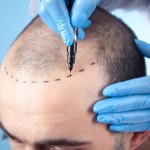 Hair Transplant Turkey and Hair Transplant Techniques
