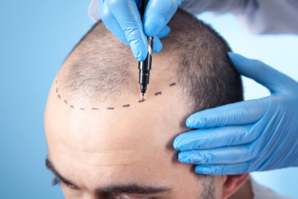 Hair Transplant Turkey and Hair Transplant Techniques