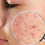 Why do pimples appear and how to cure them?