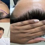 Hair Transplant