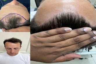 Hair Transplant