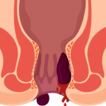 How to Treat Hemorrhoids: Home Remedies and Medical Treatments