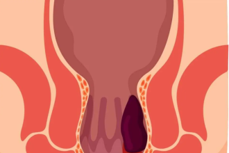 How to Treat Hemorrhoids: Home Remedies and Medical Treatments