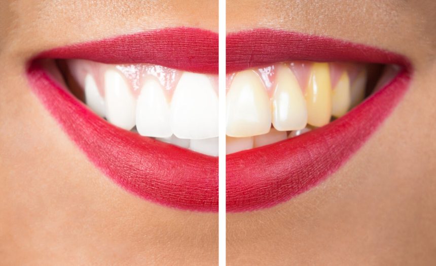 The Top Foods and Drinks That Stain Child’s Teeth
