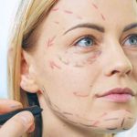 How Does a Facelift Work?