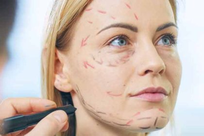 How Does a Facelift Work?