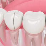 Cracked Teeth? Here's What Your Dentist Might Recommend