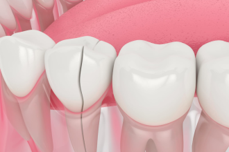 Cracked Teeth? Here's What Your Dentist Might Recommend