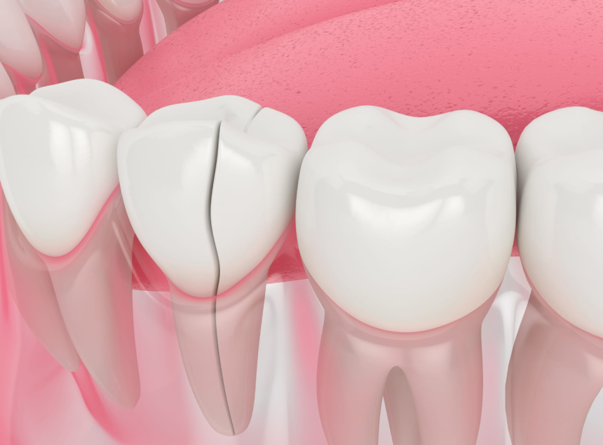 Cracked Teeth? Here's What Your Dentist Might Recommend