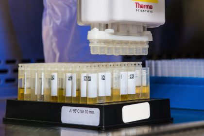 Common Health Problems That Your Pee Sample Can Reveal