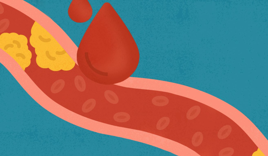 The Impact of High Cholesterol on Men