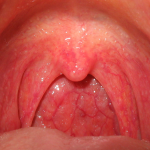 How to Treat Chronic Tonsilitis