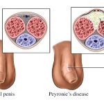 Peyronie's Disease Surgery: Understanding Treatment Options