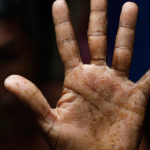 ARSENIC POISONING: WAYS TO PREVENT IT
