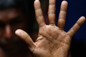 ARSENIC POISONING: WAYS TO PREVENT IT
