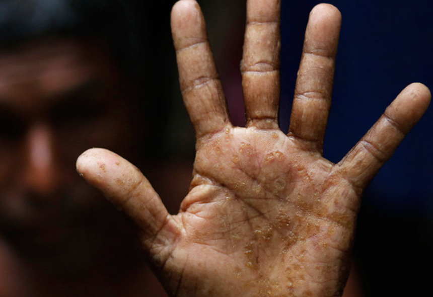 ARSENIC POISONING: WAYS TO PREVENT IT