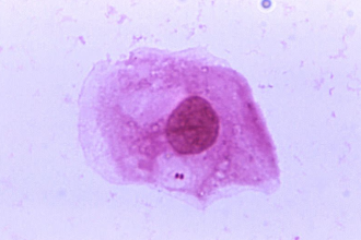 Meningococcal Disease
