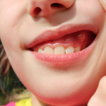 Understanding and Treating Swollen Gums Around One Tooth