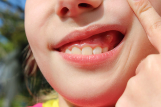 Understanding and Treating Swollen Gums Around One Tooth
